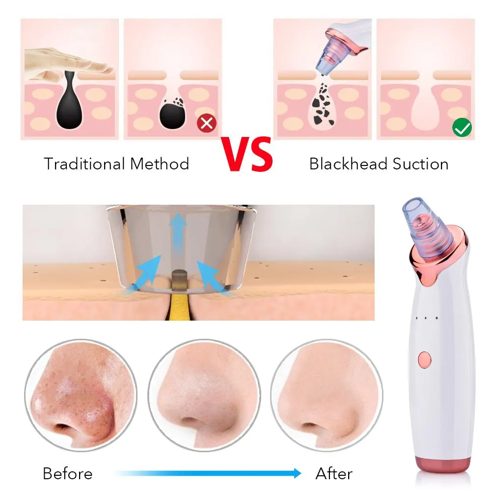 Blackhead Remover Vacuum